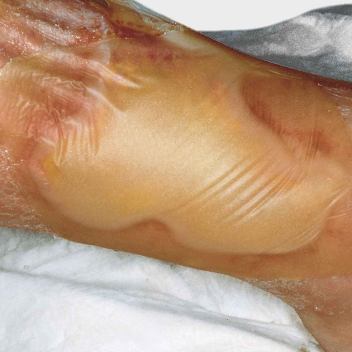 Hydrocoll Hydrocolloid Dressing 20 x 20cm