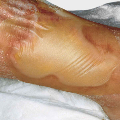 Hydrocoll Hydrocolloid Dressing 15 x 15cm