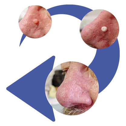 CryoPen | X+ Starter Set